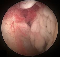 Image result for Septic Joint