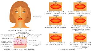 Was diegnosed with rectal herpes but there is more going on than that. Cold Sore Stages Causes Symptoms And Treatment Triclara