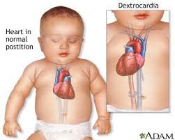 Dextrocardia is a rare condition in which the heart is on the right side. Dextrocardia Medlineplus Medical Encyclopedia