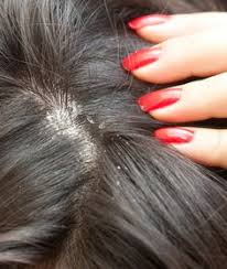 The oily scalp allows the fungus malassezia furfur to grow, which causes dandruff. 16 Best Dry Scalp Hair Care Ideas Hair Care Dry Scalp Natural Hair Styles