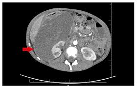 Image result for Perinephric Abscess