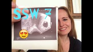 Ssw 7 Update Ultraschall Schwangerschaftswoche 7 Vlog 5 Youtube