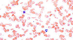 With scd, the body organs and tissues don't get enough oxygen. Crispr Could Help Us Cure Sickle Cell Disease But Patients Are Wary Mit Technology Review