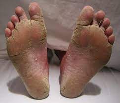 If you find these videos useful. Athlete S Foot Wikipedia