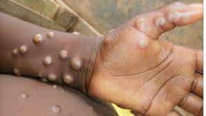 Monkeypox also caused a large outbreak in people in the united states in 2003 after the virus spread from imported african rodents to pet prairie dogs, with 47 reported human cases. Xxy2c7g6nytlom