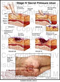 Pressure Ulcer Stages Pelo Nurse Teaching Wound Care Wound Care Nursing