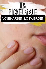 Pickelmale So Werdet Ihr Aknenarben Los Aknenarben Pickel Und Zinksalbe Gegen Pickel