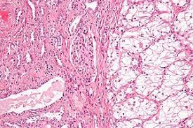 Roughly 5 to 8% of individuals have an inherited predisposition linked to several genes known to promote cancerous growth of the kidneys. Renal Cell Carcinoma Wikipedia