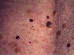 Cherry angioma is the most common type of angioma and is a common skin growth. Cherry Angioma Dermnet Nz