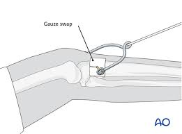 Care of the orthopedic surgical patient. Nonoperative Treatment With Limited Resources For Simple Transverse Distal 1 3 Fractures