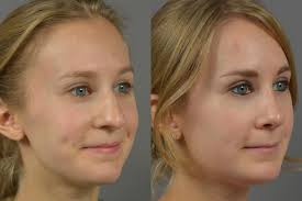 Nose Surgery Before & After Patient 14