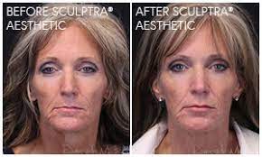 Apr 13, 2022 · sculptra® aesthetic before and after pictures. Sculptra Aesthetic Gallery Riversidemedicalarts Com