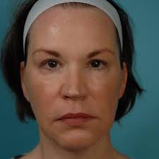 Facelift Before and After