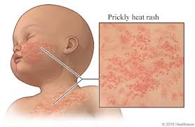 Image result for sweat rash on back baby