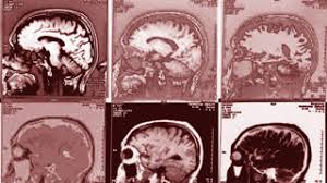 Presently, the principle utilization of brain scans for mental issues is in research studies to get familiar with the problems. No Brain Scans For Mental Illness