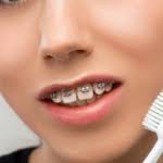 USA: przestępca ujęty dzięki gumkom ortodontycznym