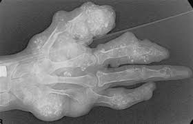 Enchondromas Pathology Orthobullets