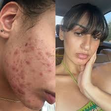 1 year results with our Venus Rose Healing Oil 😍🌹 = CLEAR, GLOWING SKIN ✨  (swipe to see what she had to say!) Venus Rose Healing Oil is formulated  to: • Target