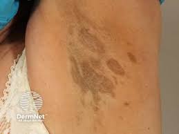 Image result for Diffuse Hyperpigmentation