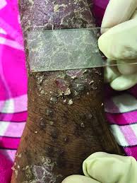 Image result for Diascopy