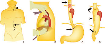 A single incision is made from the chest to the abdomen on the left side, and an incision is made in the neck. Drawings Illustrate Transhiatal Esophagectomy Without A Thoracotomy In Download Scientific Diagram