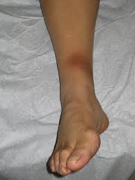 Image result for erythema nodosum