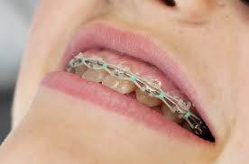 This will allow your receding gums to fix themselves. 5 Reasons Your Gums Are Swollen With Braces