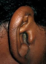 Image result for Acute Otitis Externa