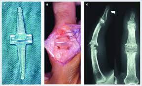 Swanson prosthetic finger joint size 4. Abbildung 3 A Swanson Silastic Spacer B Intraoperative Ansicht Bei Download Scientific Diagram