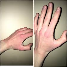 Raynaud syndrome, also known as raynaud's phenomenon, eponymously named after the physician, auguste gabriel maurice raynaud, who first described it in his doctoral thesis in 1862. Does This Look Like Raynaud S Syndrome Is There Anyway To Improve The Circulation To My Hands Medical
