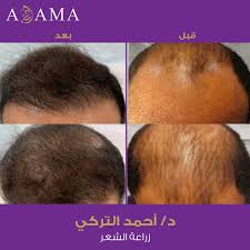 مستشفى أدمة On Twitter نتائج عمليات زراعة الشعر مع د أحمد التركي Dr Ahmedalturki استشاري زراعة الشعر بمستشفى أدمة الرياض للحجز واتس اب 0550448814 اتصال 0114660000 Https T Co Ivonllbynz