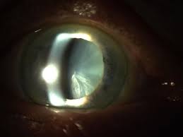 Bei der häufigsten kataraktform, der schnell fortschreitenden rindenkatarakt (cataracta corticalis), entstehen flüssigkeitsgefüllte vakuolen, die eine trübung der linsenrinde auslösen. Cataracta Corticalis Praxis Zeitz Franko Zeitz