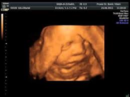 Dein baby wird größer und stärker. 3d Ultraschall Bei 28 4 29 Ssw Youtube
