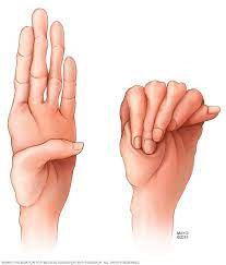 Marfan Syndrome - Symptoms And Causes - Mayo Clinic
