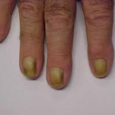 Image result for Yellow nail syndrome feet