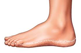 Athlete S Foot Moccasin Type Webmd Foot Remedies Athletes Foot Remedies Foot Fungus
