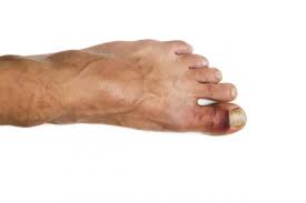 Treatment of a broken toe depends upon the severity of the fracture. Broken Toe Symptoms Pictures And Treatment