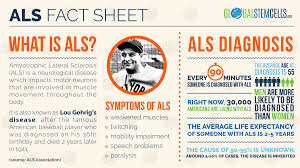 Coronary heart disease is a pathology of the heart, which is based on myocardial damage due to insufficient blood supply due to atherosclerosis and thrombosis or spasm of the coronary arteries of the heart usually occurring against it. Als Emma 35 Usa Global Stem Cells