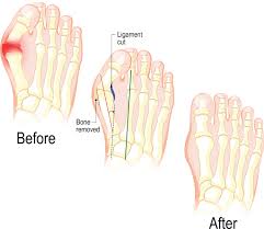 Image result for Hallux Varus