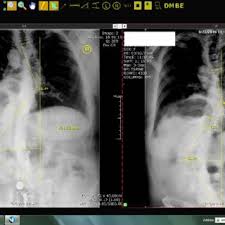 Последние твиты от scolismart (@scolismart). Pdf Radiographic Pain And Functional Outcomes In An Adult Post Fusion Patient Using A Scoliosis Activity Suit Comparative Results After 8 Months