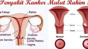 Ilustrasi kanker serviks pada remaja wanita. Vaksin Hpv Cara Terbaik Cegah Kanker Serviks Sejak Dini Tribun Manado