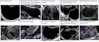 A pelvic or transvaginal ultrasound may be done to look for ovarian cancer. Ovarian Mass Differentiating Benign From Malignant The Value Of The International Ovarian Tumor Analysis Ultrasound Rules American Journal Of Obstetrics Gynecology