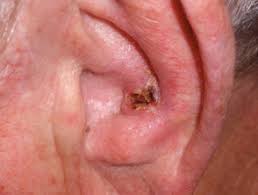 The skin graft is then trimmed to shape and sutured into the open defect. Squamous Cell Carcinoma Of The Ear Images Dermnet Nz