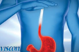 Gaviscon tablets and liquid products find you fast relief from heartburn and indigestion. Pourquoi Gavisconmd Gaviscon