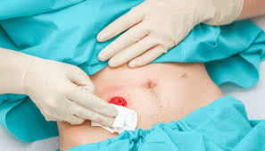 Image result for stomach hernia symptoms