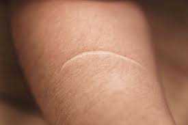 A tattoo keloid is a raised scar at the site of a tattoo. What Are The Causes Of Keloid Scars