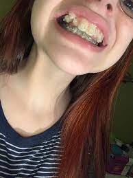 Ice decreases inflammation and swelling to help reduce pain. Feeling Really Ugly With Braces My Mouth Is So Lopsided And Unsymmetrical And My Teeth So Yellow Tips Braces