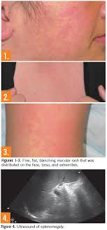 Amoxicillin and other antibiotics, including those made from penicillin, aren't recommended for people with mononucleosis. What Is Causing This Woman S Rash Consultant360