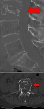 A drug with many uses. Operative Treatment Of Metastatic Breast Cancer In The Spine With Regard To Molecular Phenotypes