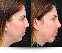 Beverly Hills Facial Plastic Surgery
